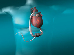 MEHANIČKA PUMPA ugrađena u pacijentovo tijelo preuzima funkciju srca i pumpa krv kroz organizam. Izrađena je od  visokokvalitetnih tehnoloških materijala
