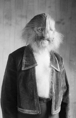 Stephan Bibrowski (1891–1932), poznat i pod izvođačkim imenom Lionel, čovjek sa lavljom glavom bolovao je od sindroma vukodlaka