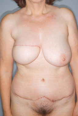 Forming the breast with visible incisions